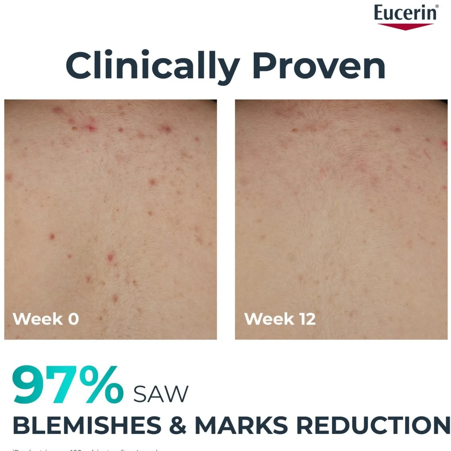 Eucerin DERMOPURE Clinical Correcting Body Care 200ml (6.76floz)
