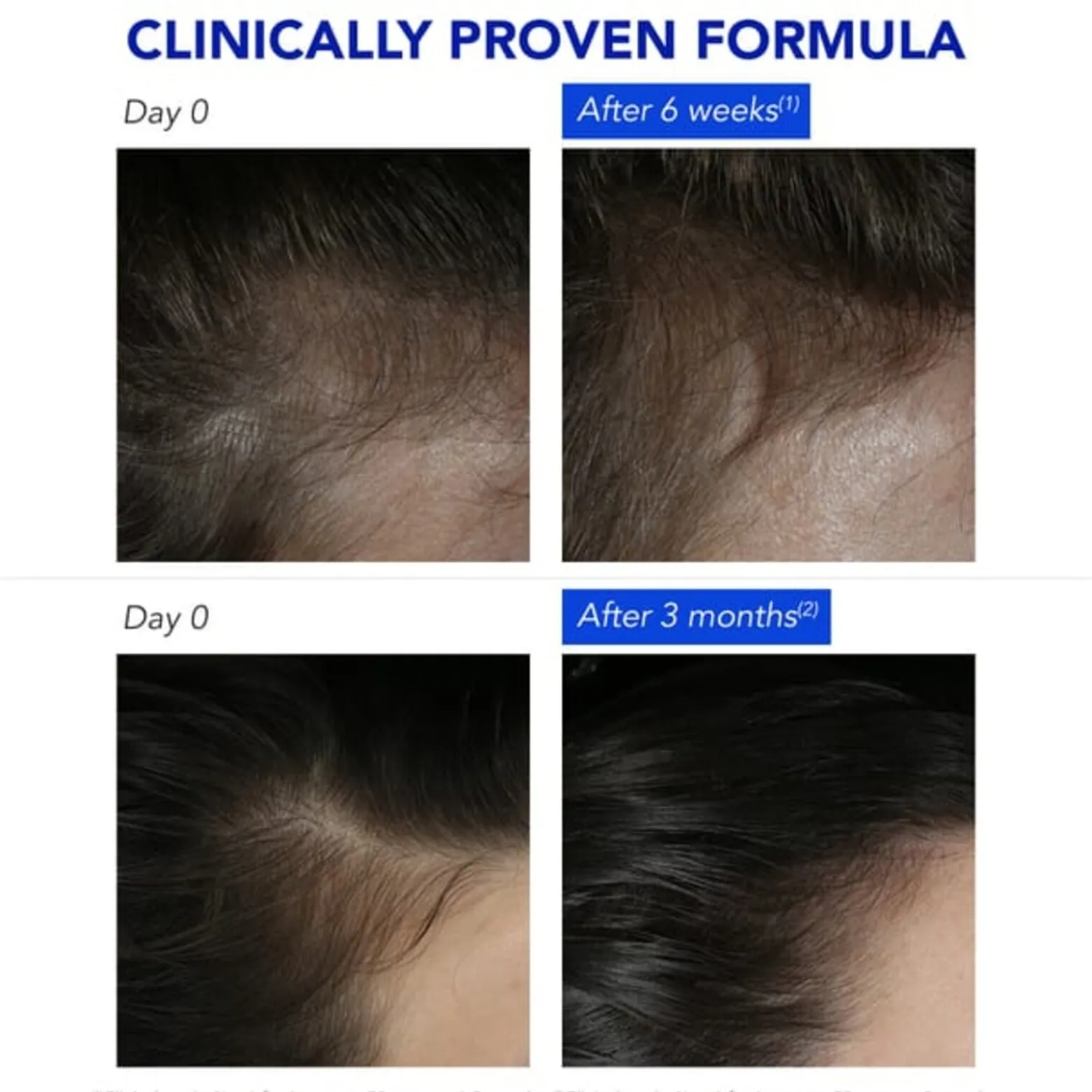 Phytophanere Anti-Reactive Hair Loss Treatment 12x5ml (12x0.17floz)