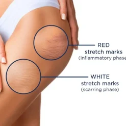 Rilastil Smagliature Stretch Marks Ampoules 10x5ml (10x0.17fl oz)